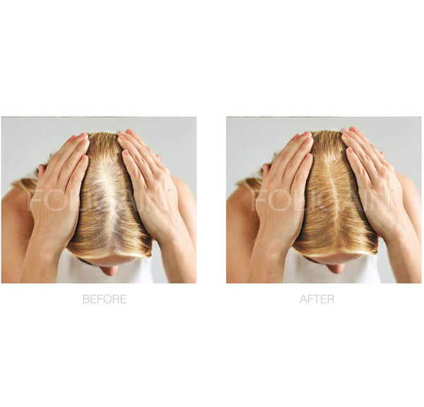 FOLIGAIN Minoxidil 2% Hair Regrowth Treatment For Women 3 Month Supply