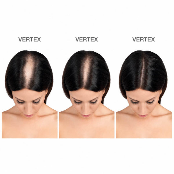 FOLIGAIN® Women's Hair Regrowth Kit - FOLIGAIN UNITED KINGDOM