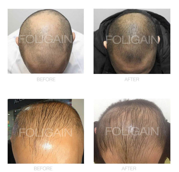 FOLIGAIN® Men's Hair Regrowth Kit - FOLIGAIN UNITED KINGDOM