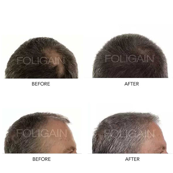 FOLIGAIN® Men's Hair Regrowth Kit - FOLIGAIN UNITED KINGDOM