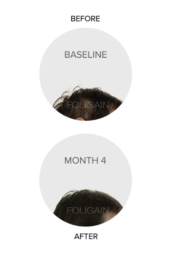 FOLIGAIN Triple Action Complete Formula For Thinning Hair For Women with 10% Trioxidil