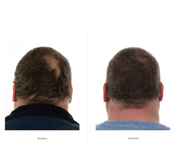 FOLIGAIN Triple Action Complete Formula For Thinning Hair For Men 10% Trioxidil