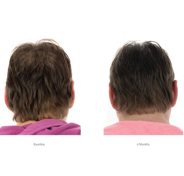 FOLIGAIN® Women's Hair Regrowth Kit - FOLIGAIN UNITED KINGDOM